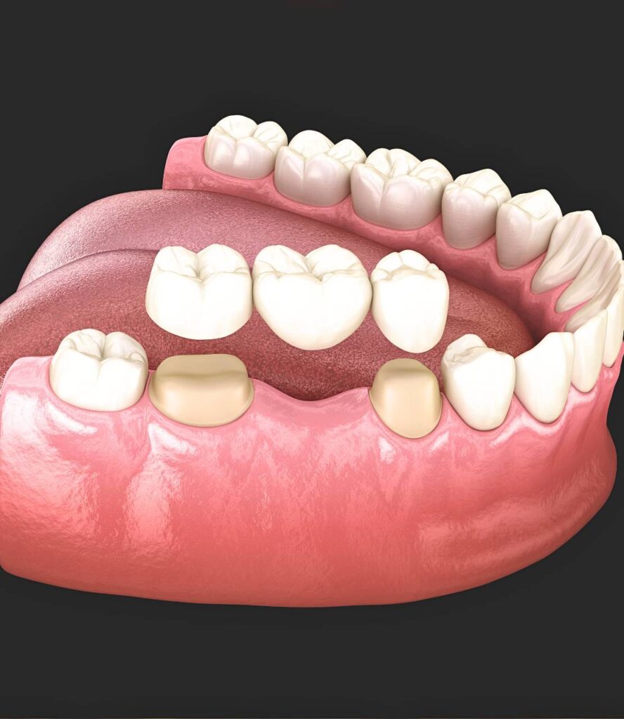 Dental bridge