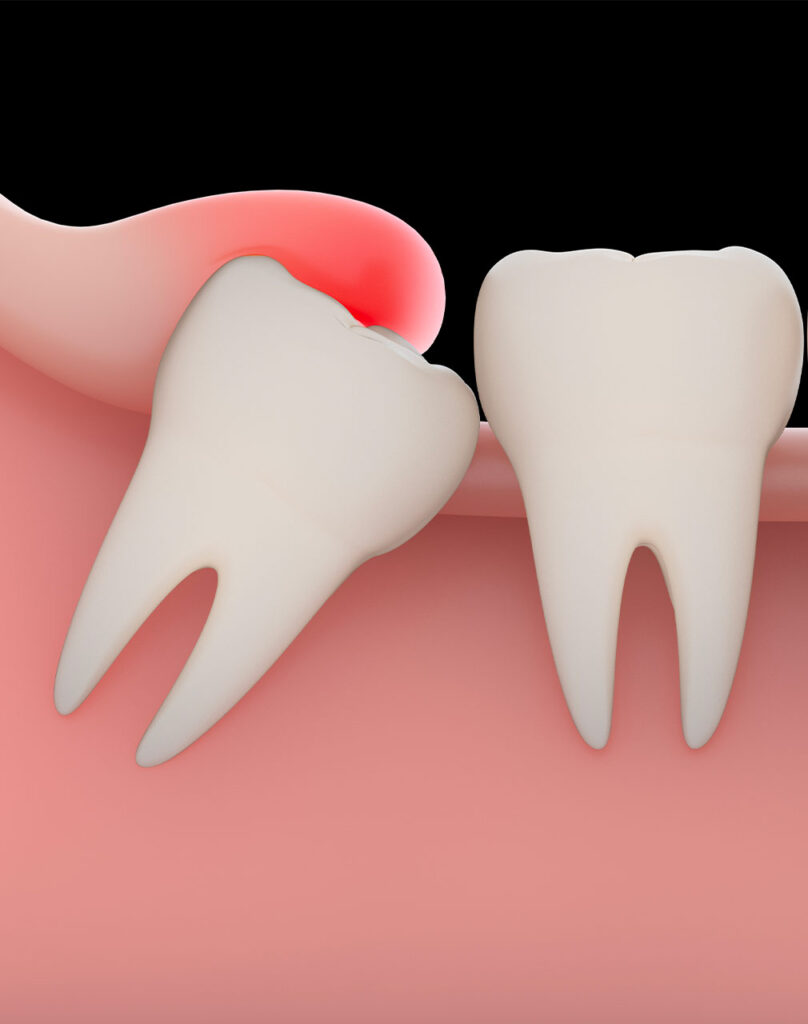Extraction des dents de sagesse