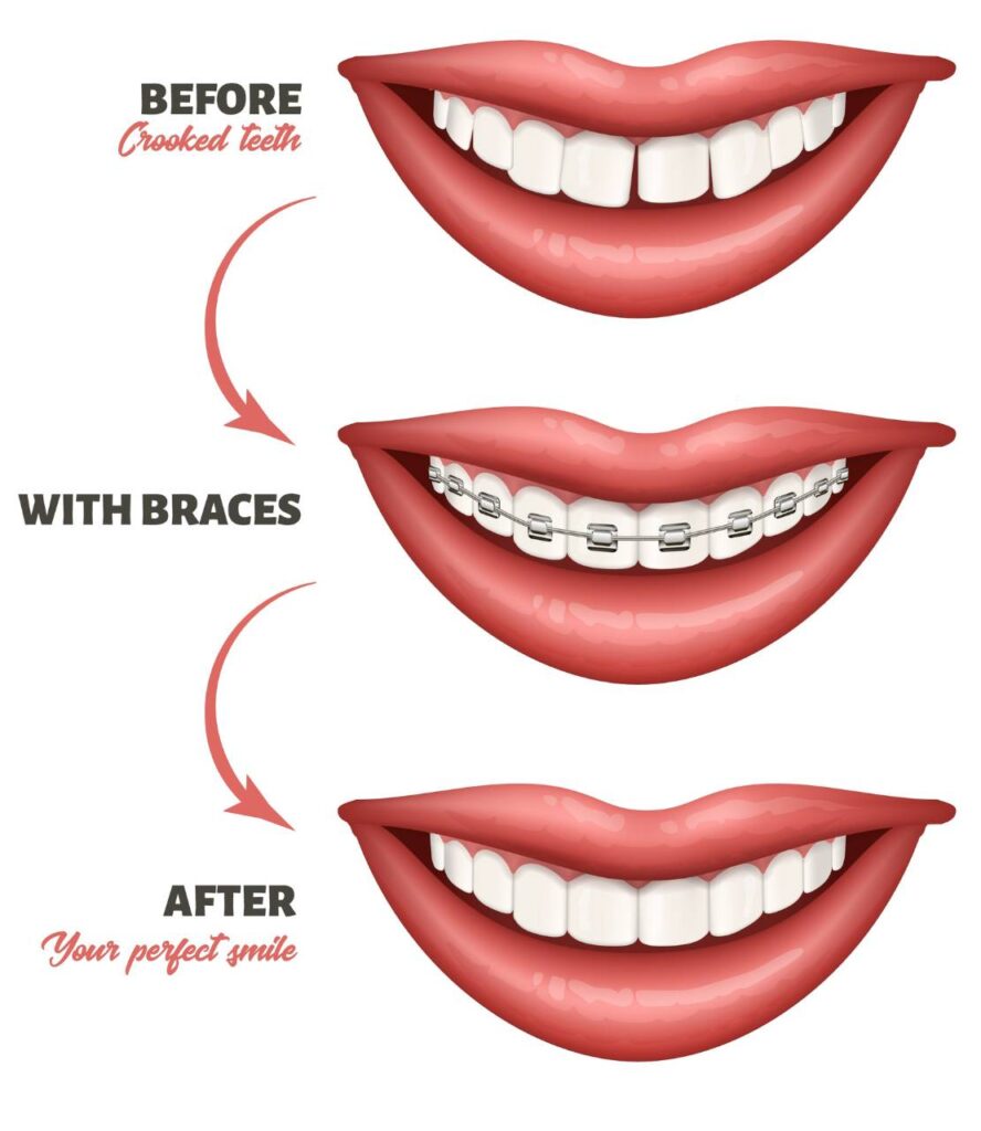 Orthodontie adultes