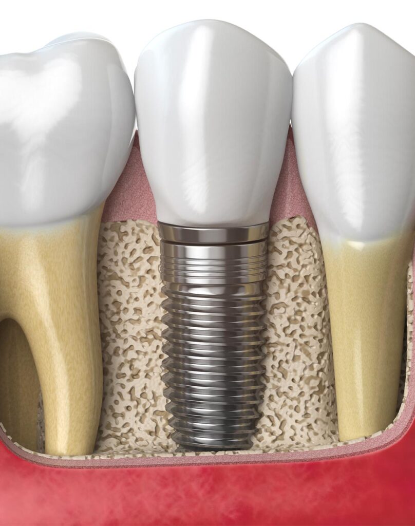 Implants dentaires