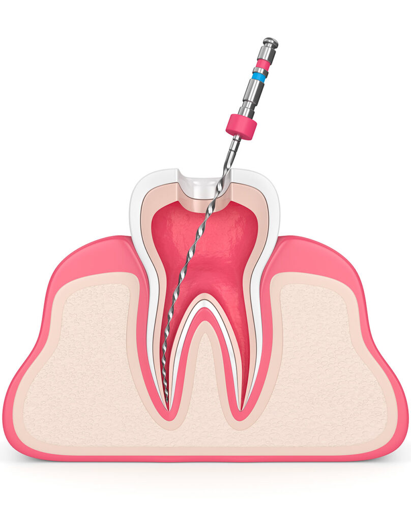 Root canal treatment