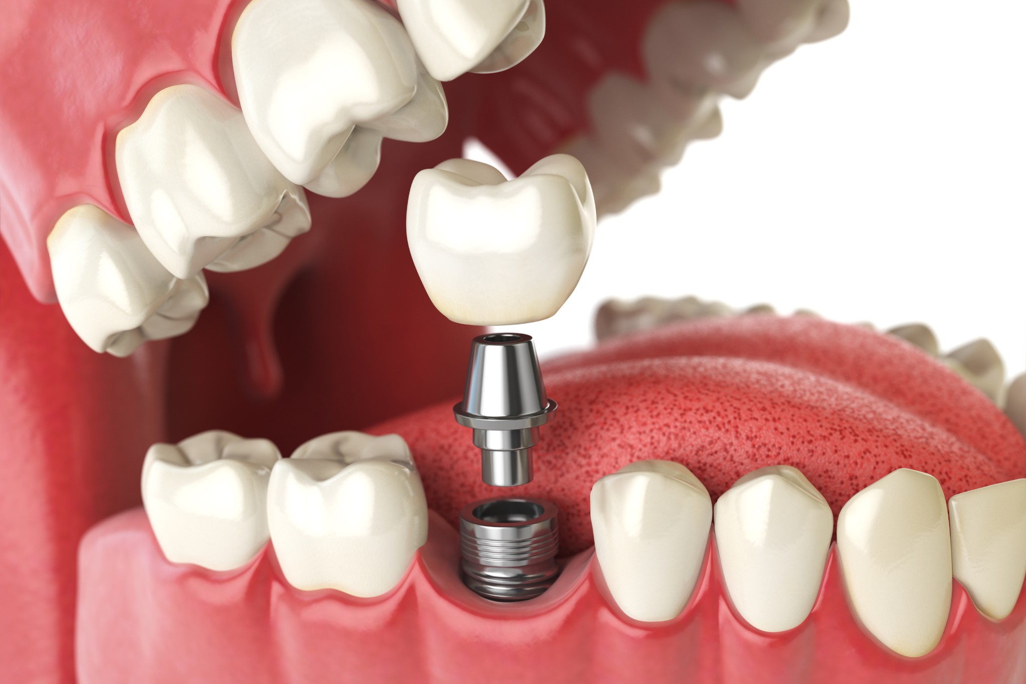 Dental implant Geneva