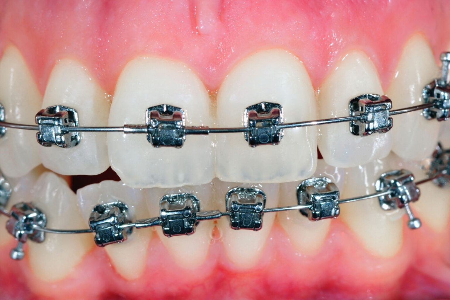 Orthodontie, bagues, Invisalign