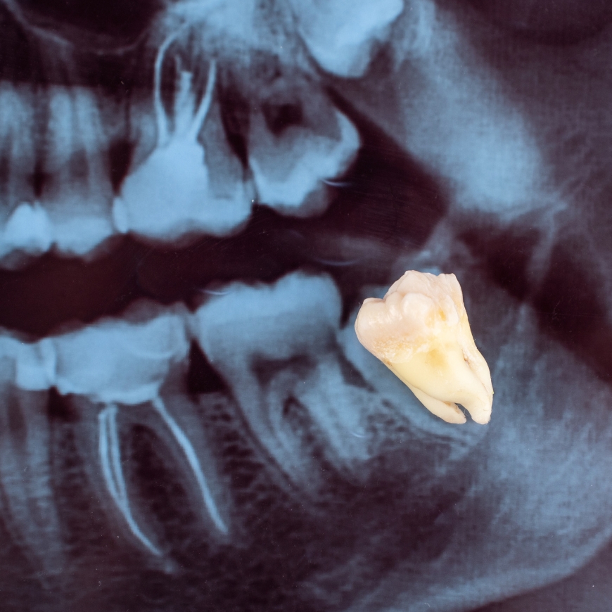 Extraction des dents de sagesse Genève