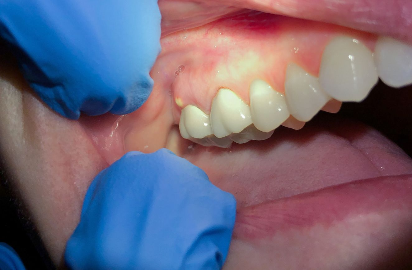 White bump in the mouth