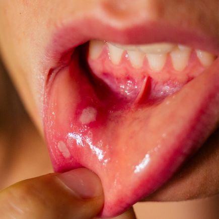 White bump on the lower lip