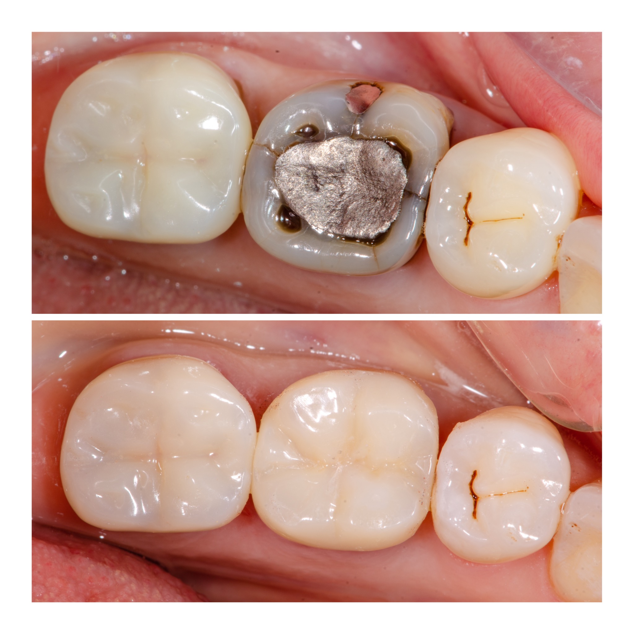Onlay avant après Dentiste Genève