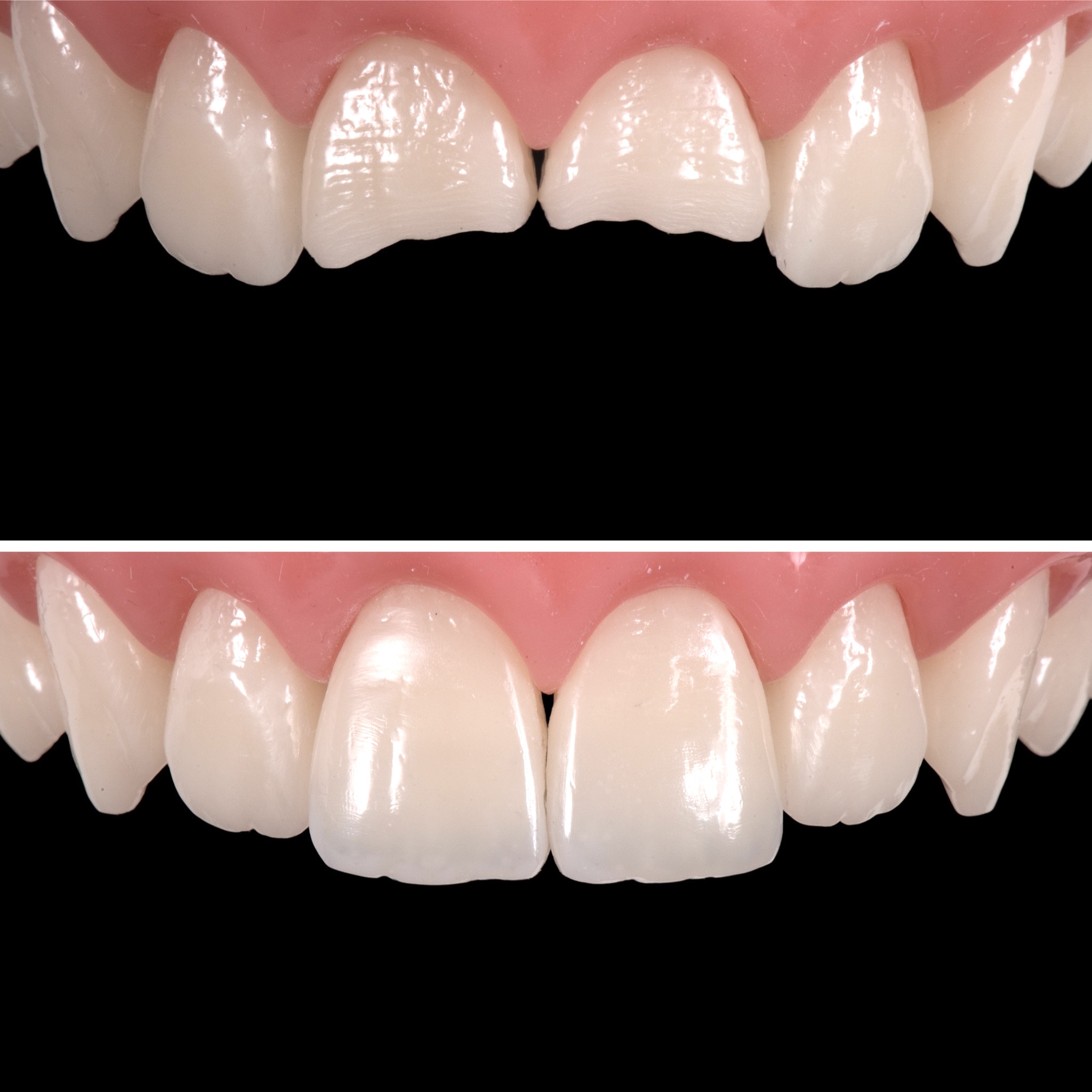 avant après composite dentaire Genève dentiste